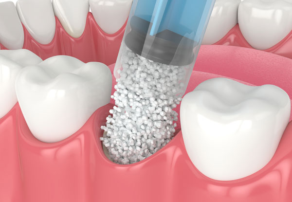 socket graft illustration