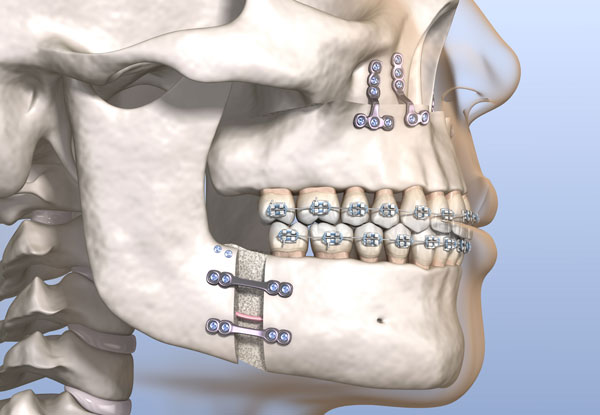 illustration of jaw surgery