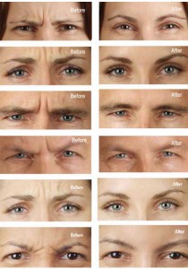 before-after