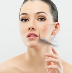 Chemical Peel